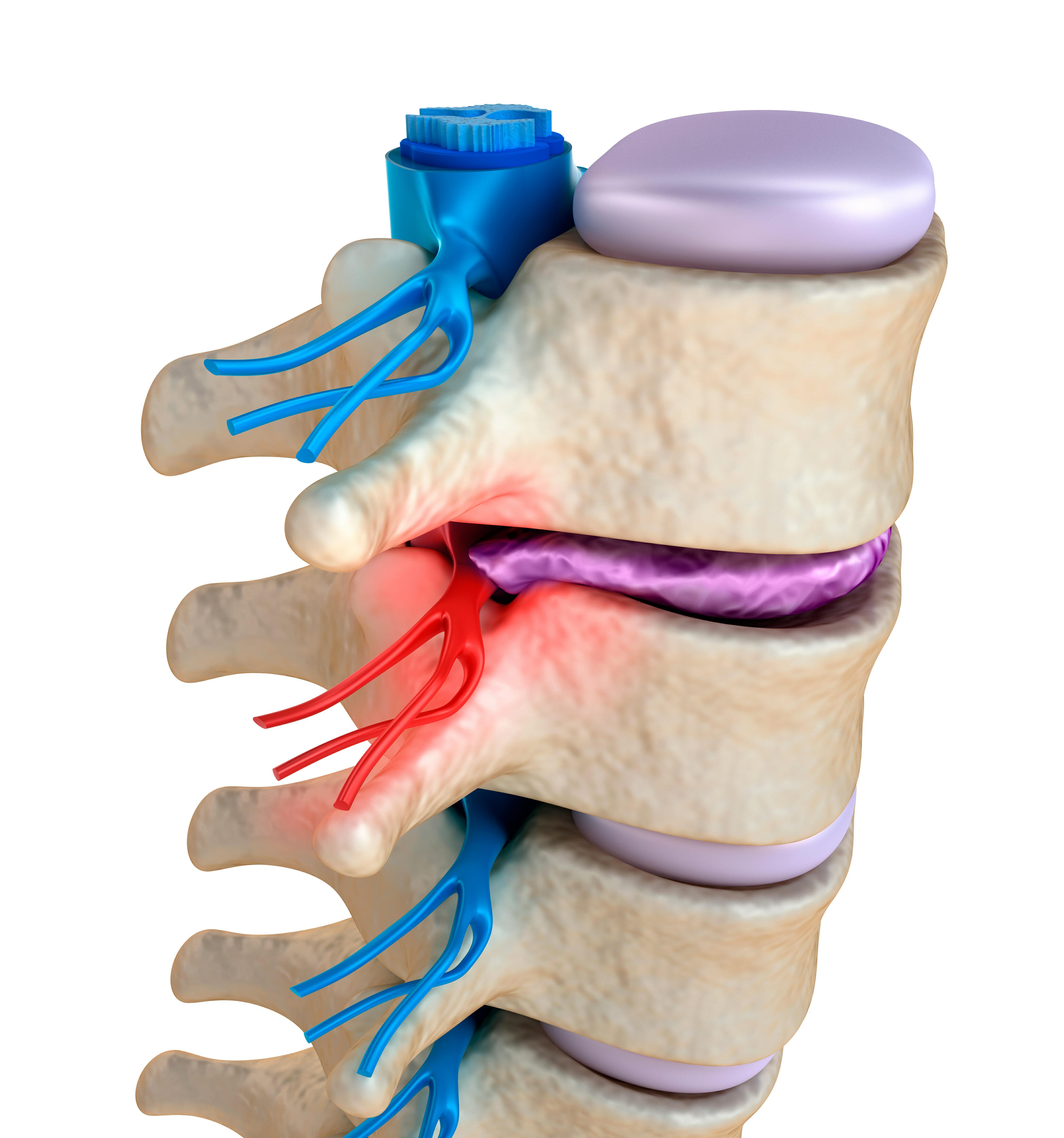 -Nerve Pinched Nerve in Lower Back? Effective Remedies and What You Need to Know