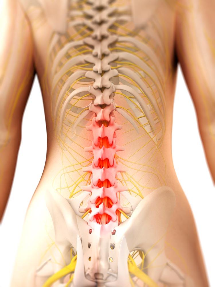 -spine Pinched Nerve in Lower Back? Effective Remedies and What You Need to Know