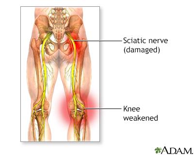 sciatic nerve pain relief