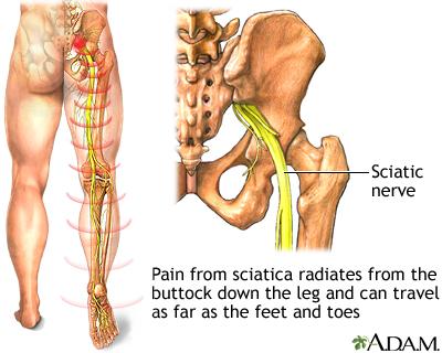 19503 Sciatica Explained: Top Causes and Triggers You Need to Know