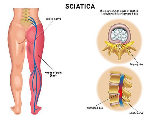 sciatica