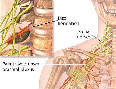 pinched nerve in lower back