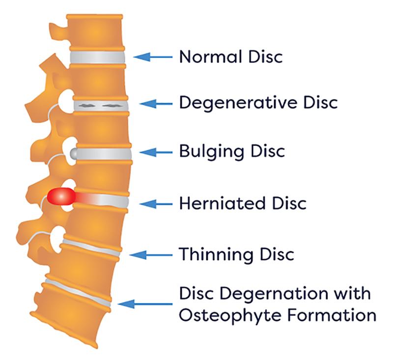 Disc-1 Reclaim Your Life: Effective Herniated Disc Treatment for Immediate Relief