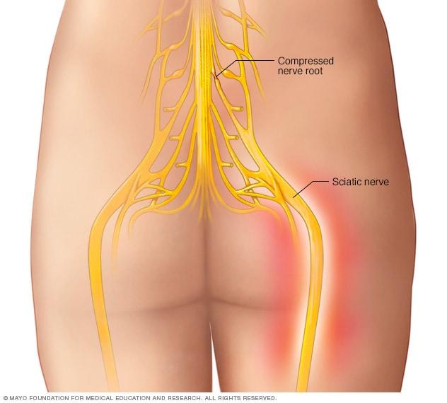 hu_jpg Sciatica Explained: Top Causes and Triggers You Need to Know