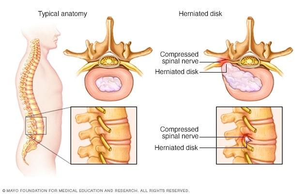 k-8col Discover the Truth About Herniated Discs: Symptoms, Causes & Effective Treatments