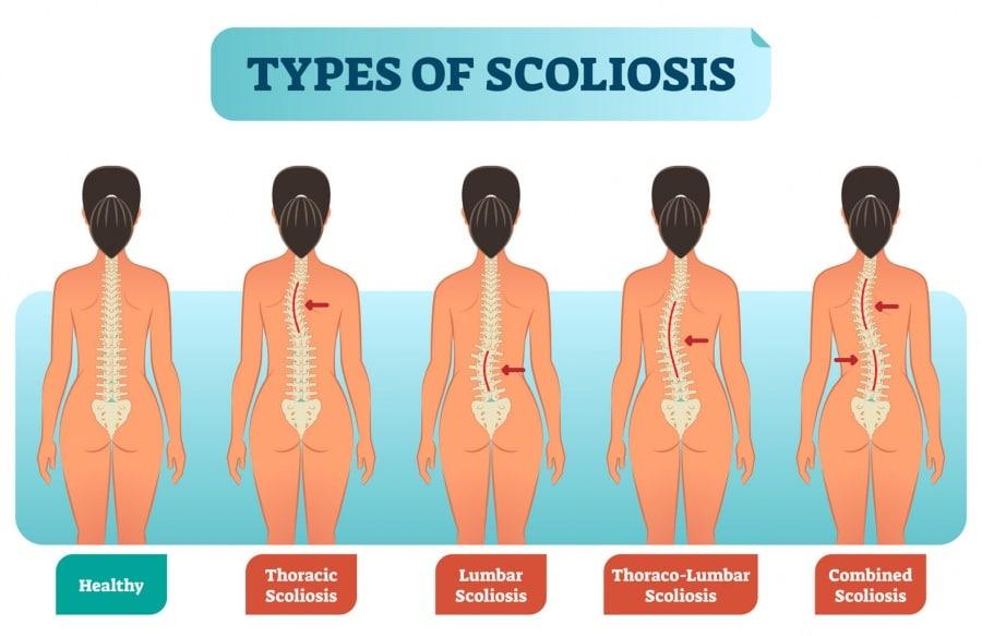 liosis Scoliosis Decoded: Understanding Causes, Symptoms, and the Best Treatment Strategies