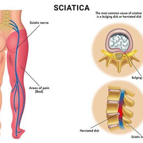 Sciatica Explained: Top Causes and Triggers You Need to Know